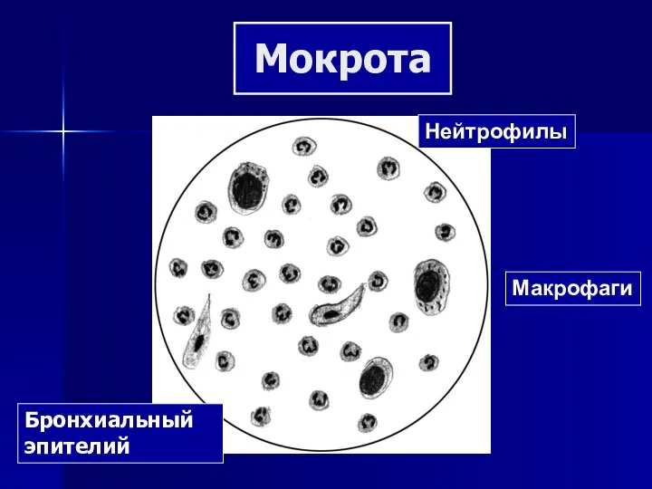 Мокрота Нейтрофилы Макрофаги Бронхиальный эпителий