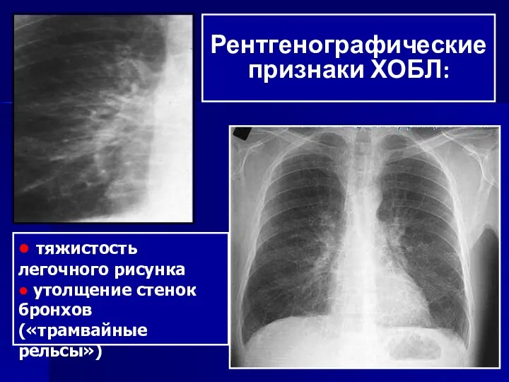 ● тяжистость легочного рисунка ● утолщение стенок бронхов («трамвайные рельсы») Рентгенографические признаки ХОБЛ: