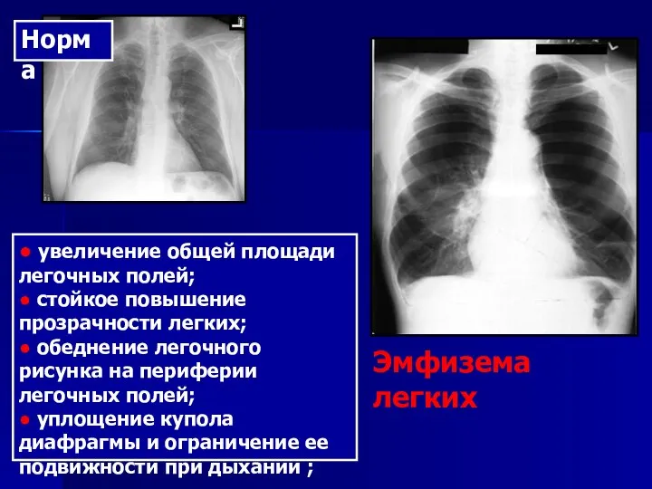 ● увеличение общей площади легочных полей; ● стойкое повышение прозрачности легких;