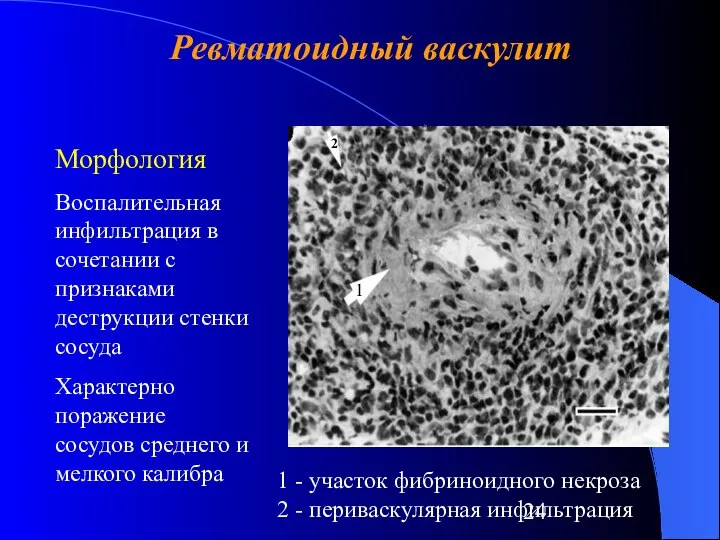 Ревматоидный васкулит 1 2 Морфология Воспалительная инфильтрация в сочетании с признаками