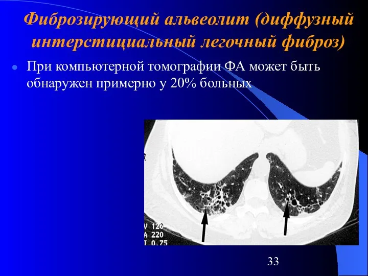 При компьютерной томографии ФА может быть обнаружен примерно у 20% больных