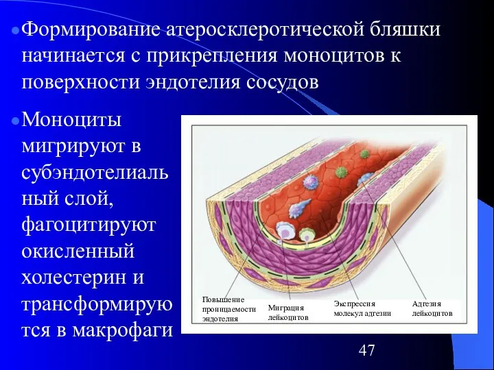 Формирование атеросклеротической бляшки начинается с прикрепления моноцитов к поверхности эндотелия сосудов