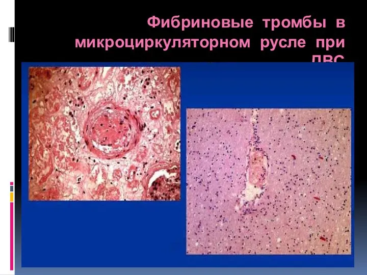 Фибриновые тромбы в микроциркуляторном русле при ДВС