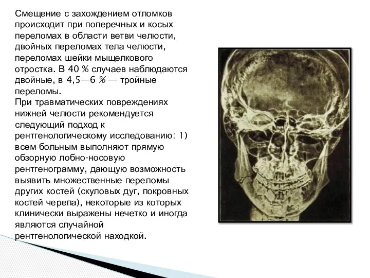 Смещение с захождением отломков происходит при поперечных и косых переломах в