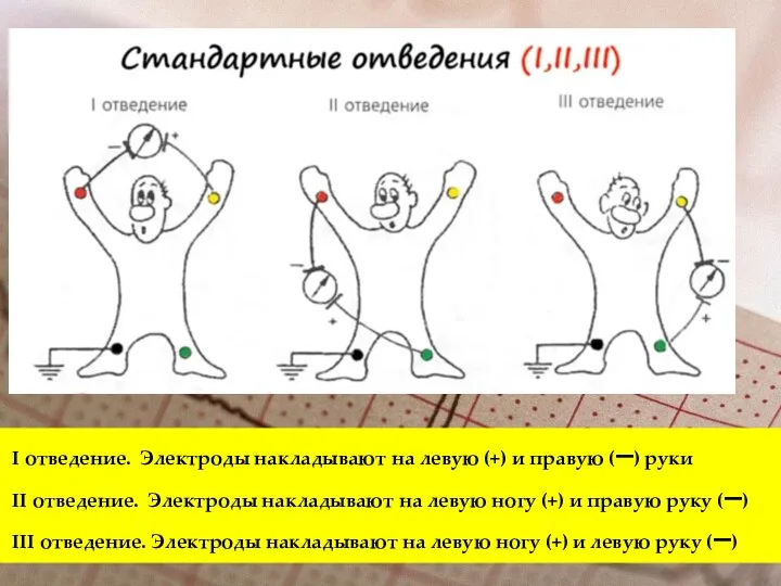 I отведение. Электроды накладывают на левую (+) и правую (–) руки