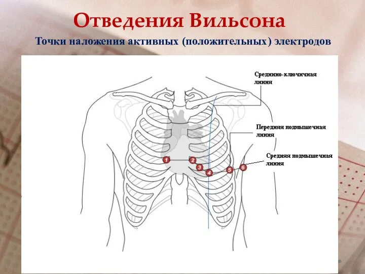 Отведения Вильсона Точки наложения активных (положительных) электродов