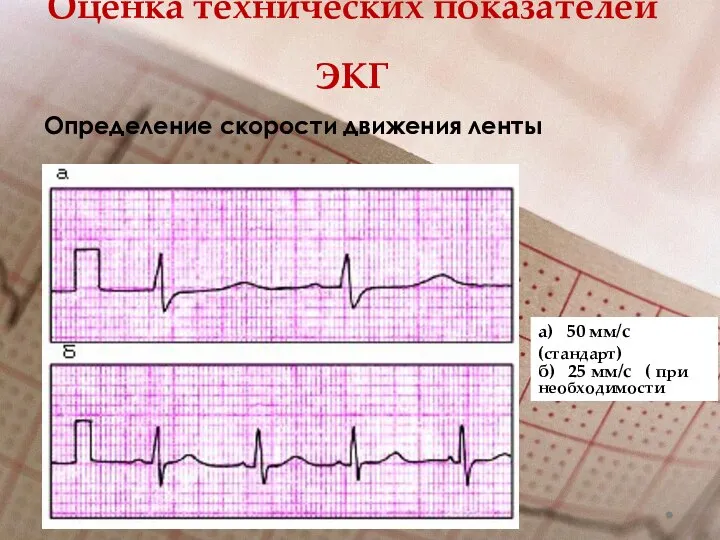 Оценка технических показателей ЭКГ Определение скорости движения ленты а) 50 мм/с