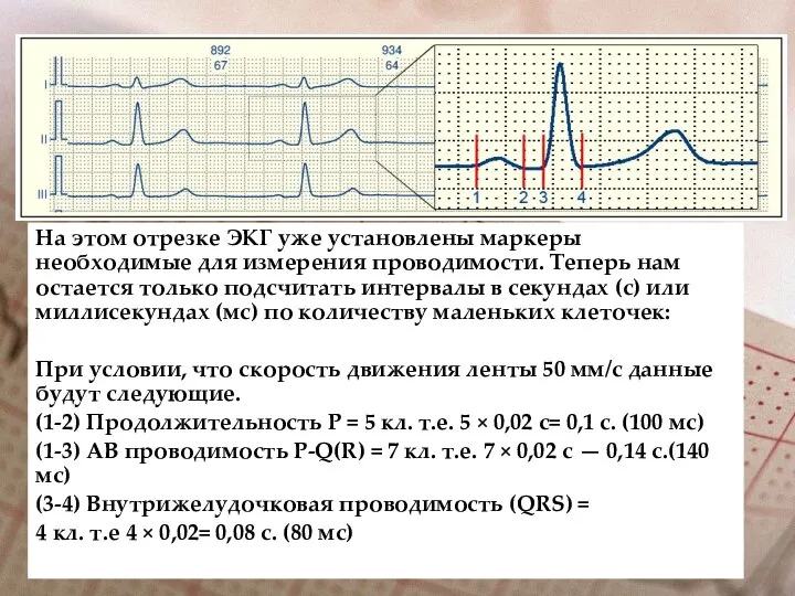 На этом отрезке ЭКГ уже установлены маркеры необходимые для измерения проводимости.