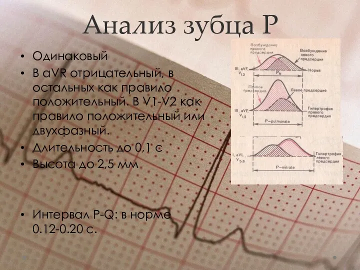 Анализ зубца Р Одинаковый В aVR отрицательный, в остальных как правило