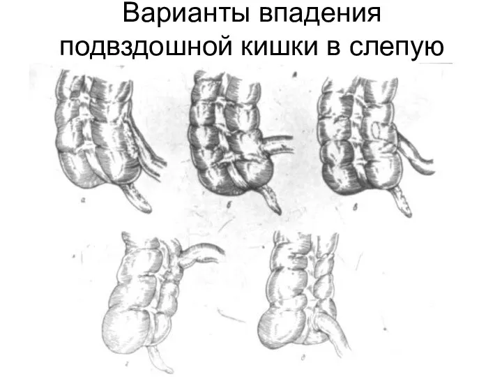 Варианты впадения подвздошной кишки в слепую