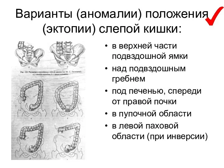 Варианты (аномалии) положения (эктопии) слепой кишки: в верхней части подвздошной ямки