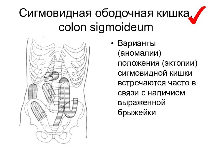 Сигмовидная ободочная кишка, colon sigmoideum Варианты (аномалии) положения (эктопии) сигмовидной кишки