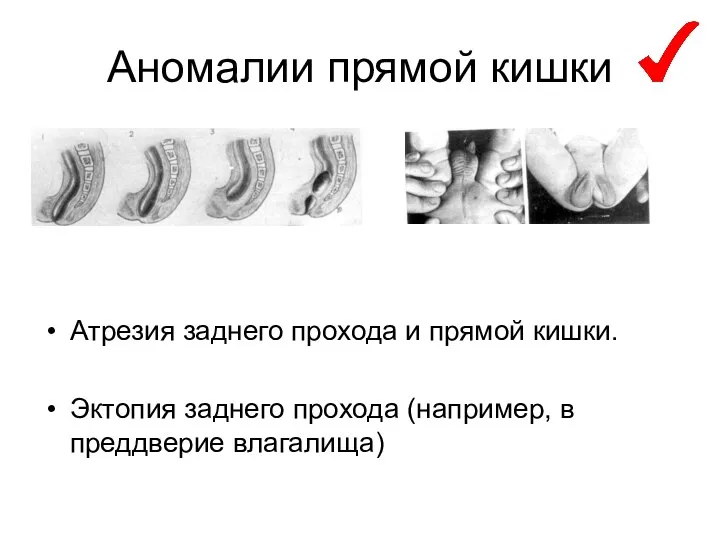 Аномалии прямой кишки Атрезия заднего прохода и прямой кишки. Эктопия заднего прохода (например, в преддверие влагалища)