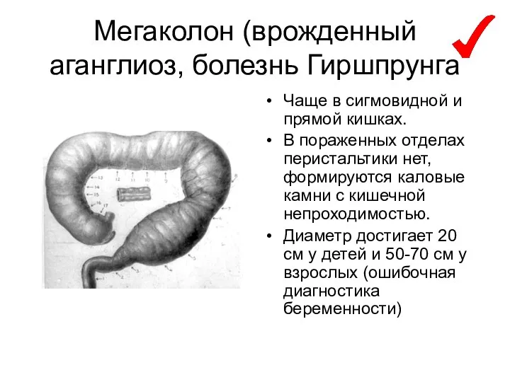 Мегаколон (врожденный аганглиоз, болезнь Гиршпрунга Чаще в сигмовидной и прямой кишках.