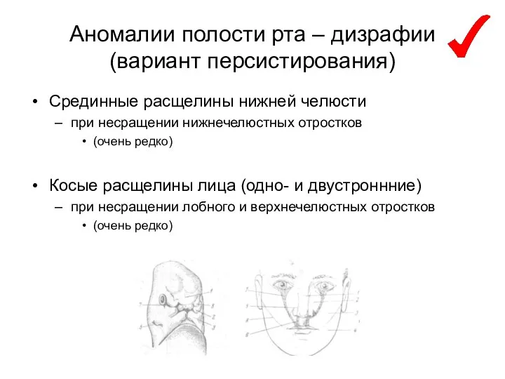 Аномалии полости рта – дизрафии (вариант персистирования) Срединные расщелины нижней челюсти