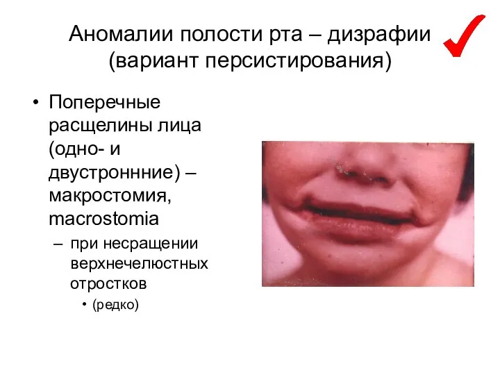 Аномалии полости рта – дизрафии (вариант персистирования) Поперечные расщелины лица (одно-