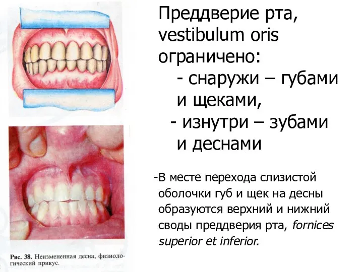 Преддверие рта, vestibulum oris ограничено: - снаружи – губами и щеками,