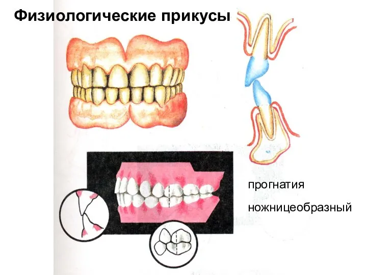 прогнатия ножницеобразный Физиологические прикусы