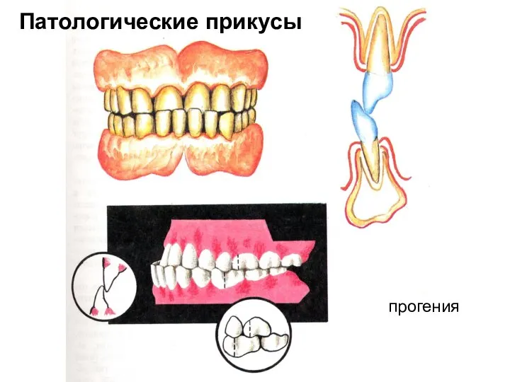 прогения Патологические прикусы