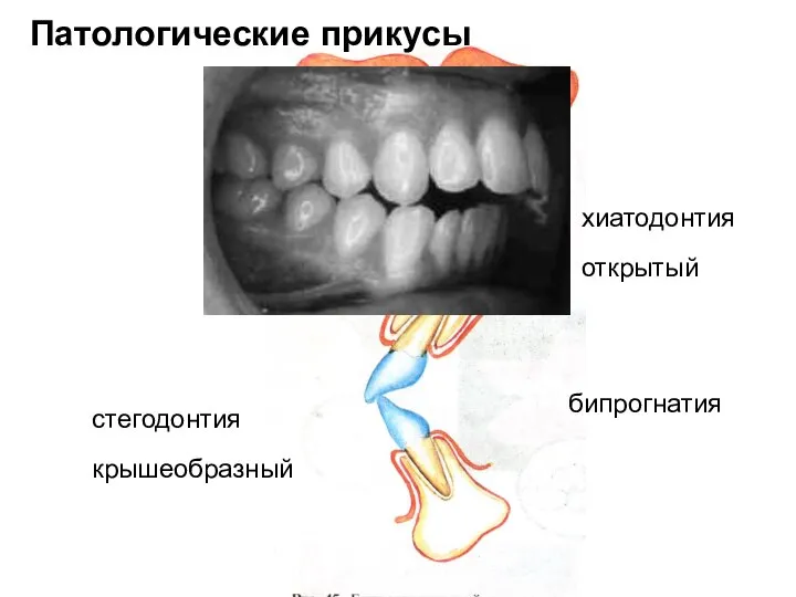 бипрогнатия хиатодонтия открытый Патологические прикусы стегодонтия крышеобразный