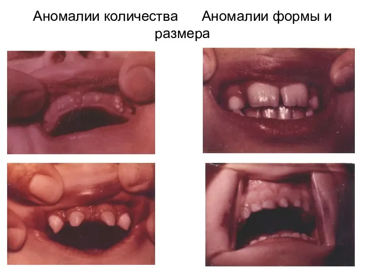 Аномалии количества Аномалии формы и размера