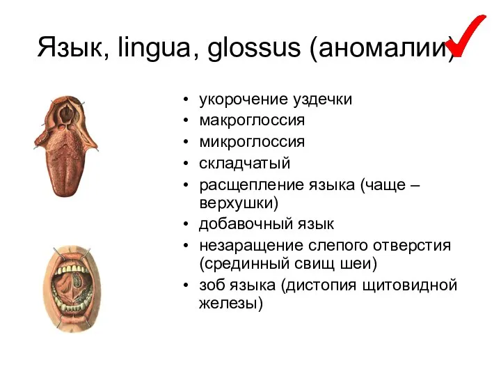 Язык, lingua, glossus (аномалии): укорочение уздечки макроглоссия микроглоссия складчатый расщепление языка