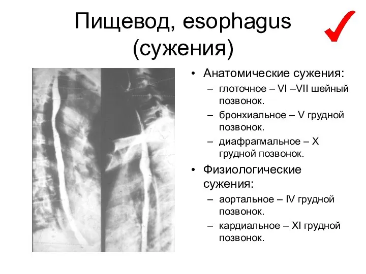 Пищевод, esophagus (сужения) Анатомические сужения: глоточное – VI –VII шейный позвонок.