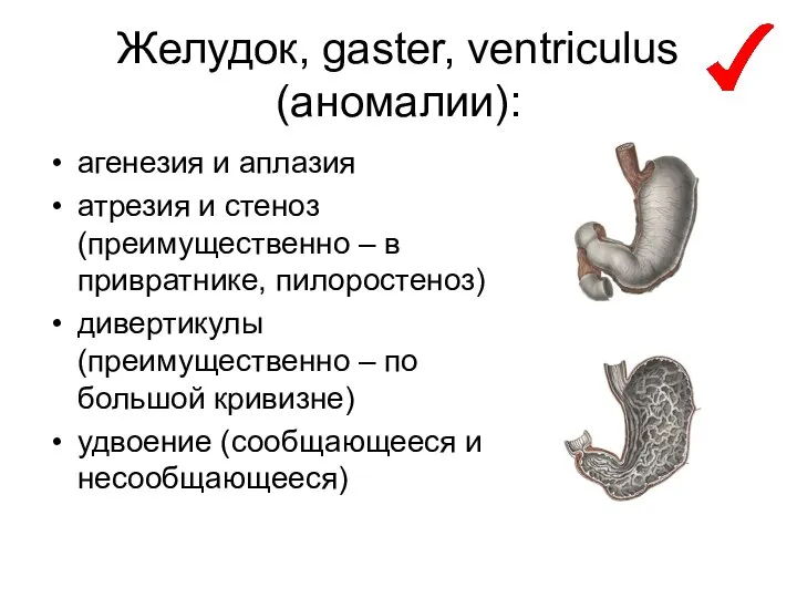 Желудок, gaster, ventriculus (аномалии): агенезия и аплазия атрезия и стеноз (преимущественно