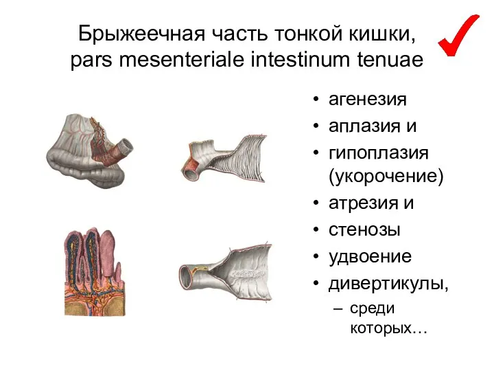 Брыжеечная часть тонкой кишки, pars mesenteriale intestinum tenuae агенезия аплазия и