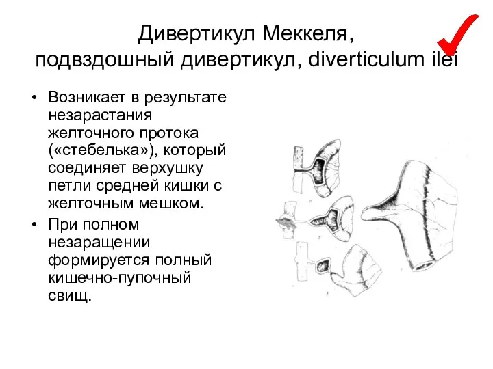 Дивертикул Меккеля, подвздошный дивертикул, diverticulum ilei Возникает в результате незарастания желточного