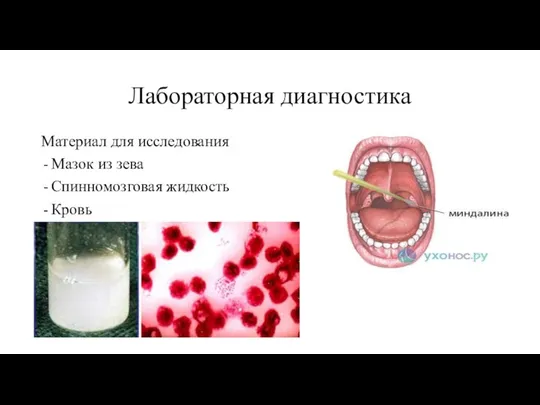 Лабораторная диагностика Материал для исследования Мазок из зева Спинномозговая жидкость Кровь