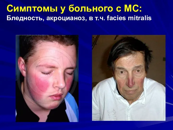 Симптомы у больного с МС: Бледность, акроцианоз, в т.ч. facies mitralis