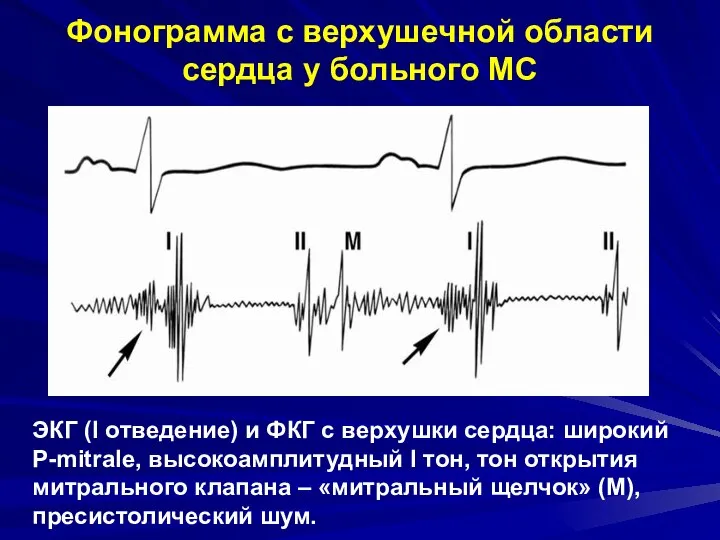 Фонограмма с верхушечной области сердца у больного МС ЭКГ (I отведение)