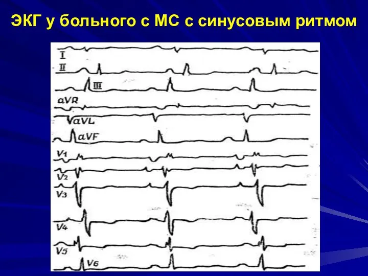 ЭКГ у больного с МС с синусовым ритмом