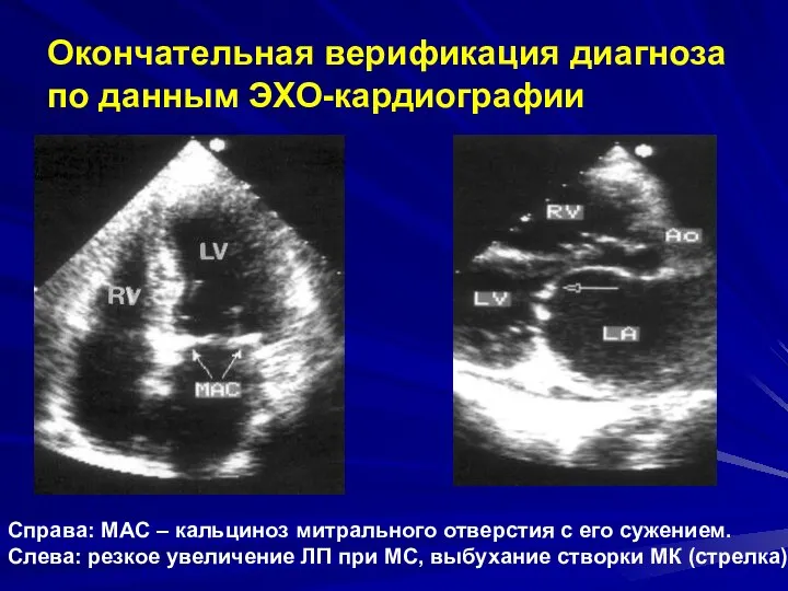 Окончательная верификация диагноза по данным ЭХО-кардиографии Справа: MAC – кальциноз митрального