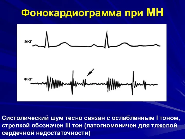 Фонокардиограмма при МН Систолический шум тесно связан с ослабленным I тоном,