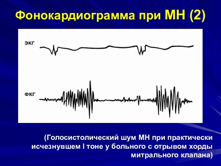 Фонокардиограмма при МН (2) (Голосистолический шум МН при практически исчезнувшем I