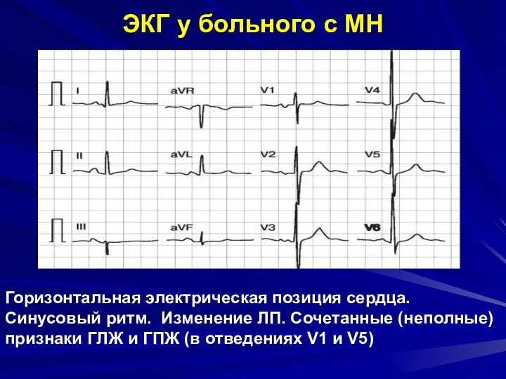 ЭКГ у больного с МН Горизонтальная электрическая позиция сердца. Синусовый ритм.