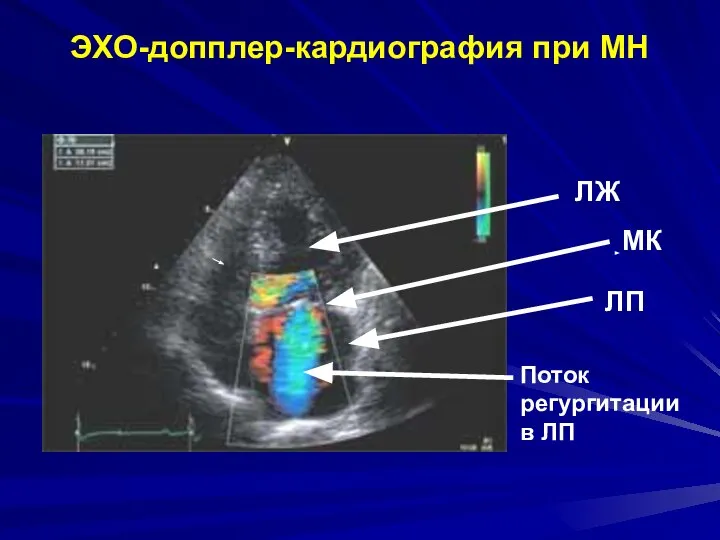 ЭХО-допплер-кардиография при МН ЛЖ ЛП МК Поток регургитации в ЛП