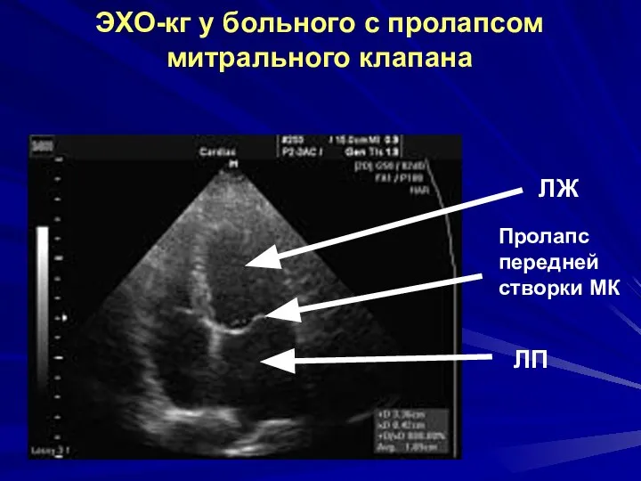 Пролапс передней створки МК ЛП ЛЖ ЭХО-кг у больного с пролапсом митрального клапана