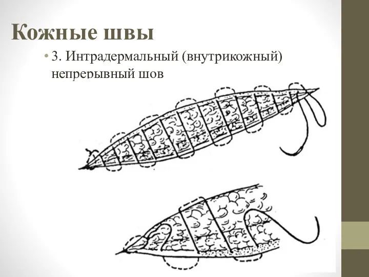 Кожные швы 3. Интрадермальный (внутрикожный) непрерывный шов