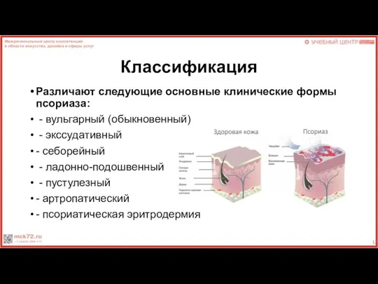 Классификация Различают следующие основные клинические формы псориаза: - вульгарный (обыкновенный) -