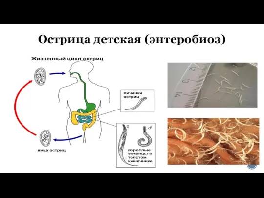 Острица детская (энтеробиоз)