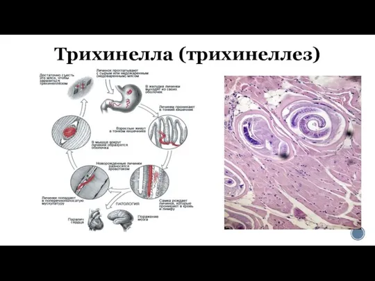 Трихинелла (трихинеллез)