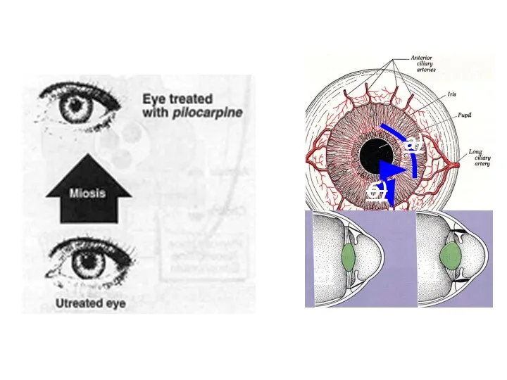 Effects on acetylcholine receptors: M-cholinomimetics Effect on the eye: а) б) а) б)