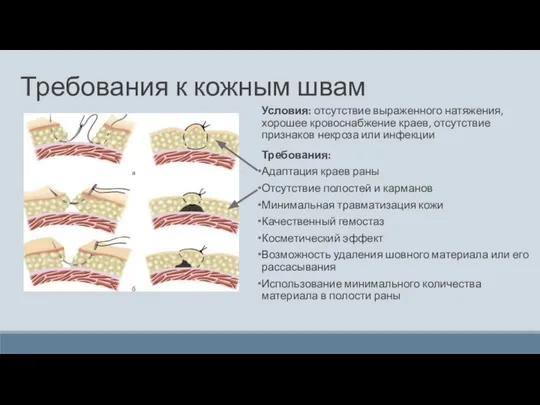 Требования к кожным швам Условия: отсутствие выраженного натяжения, хорошее кровоснабжение краев,