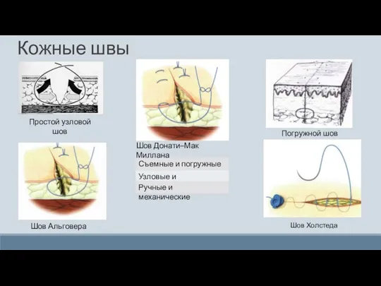 Кожные швы Узловые и непрерывные Съемные и погружные Ручные и механические