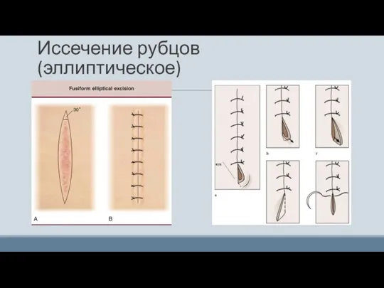 Иссечение рубцов (эллиптическое)