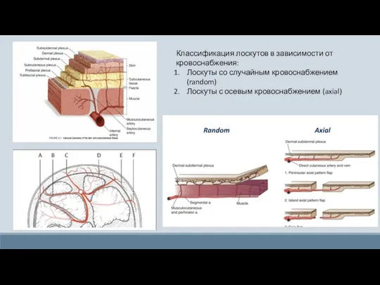 Классификация лоскутов в зависимости от кровоснабжения: Лоскуты со случайным кровоснабжением (random) Лоскуты с осевым кровоснабжением (axial)