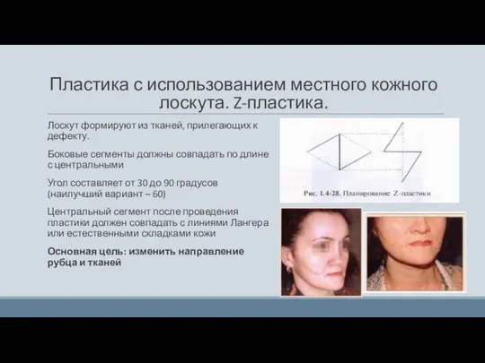 Пластика с использованием местного кожного лоскута. Z-пластика. Лоскут формируют из тканей,